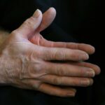 Close-up of a hand showing swollen finger joints associated with arthritis