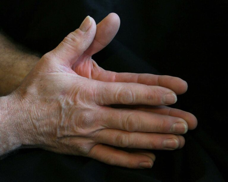 Close-up of a hand showing swollen finger joints associated with arthritis
