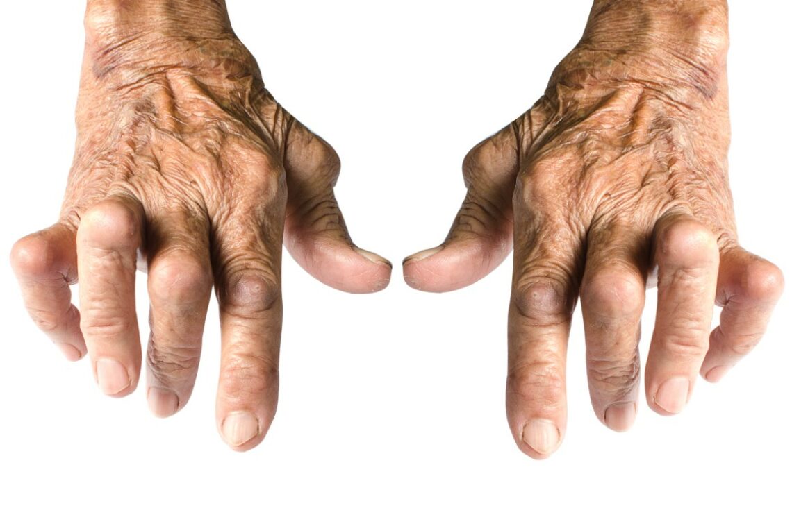 Rheumatoid Arthritis Live-in Care